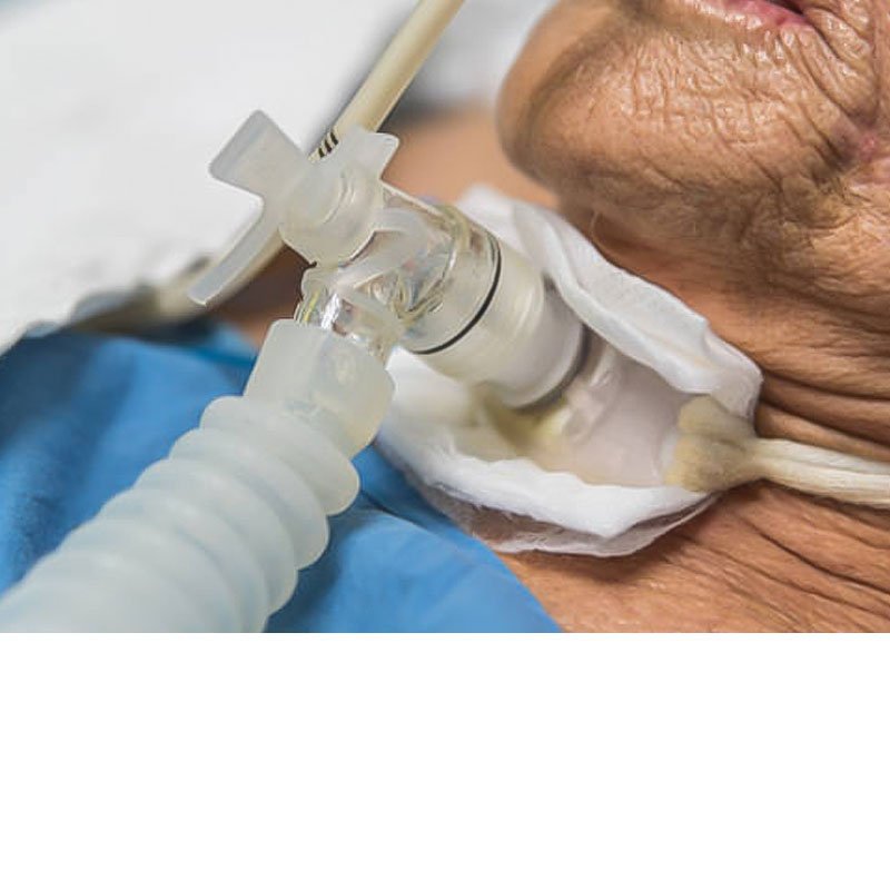 Tracheostomy 