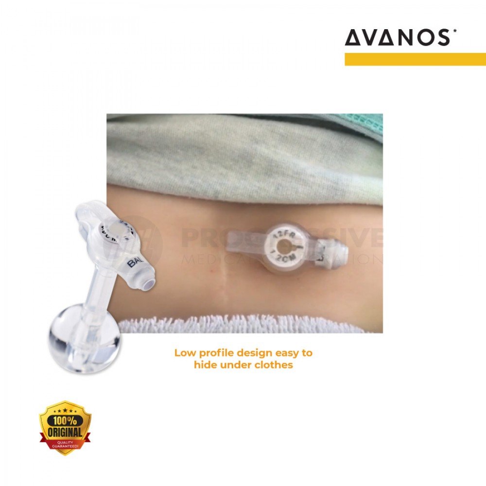 Avanos MIC-key Low Profile Feeding Tube