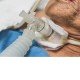 Tracheostomy Tracheostomy