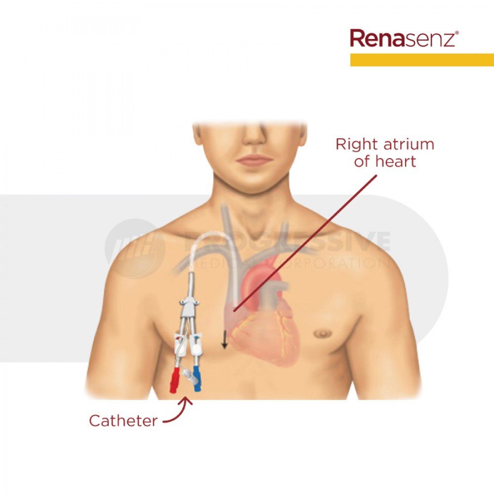 Renasenz Hemodialysis Kit 2-Lumen Fr 12x16 Curved Standard