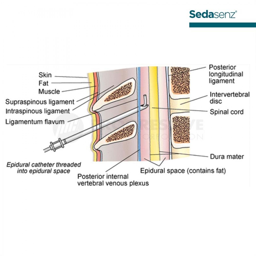 Sedasenz Epidural Kit G18