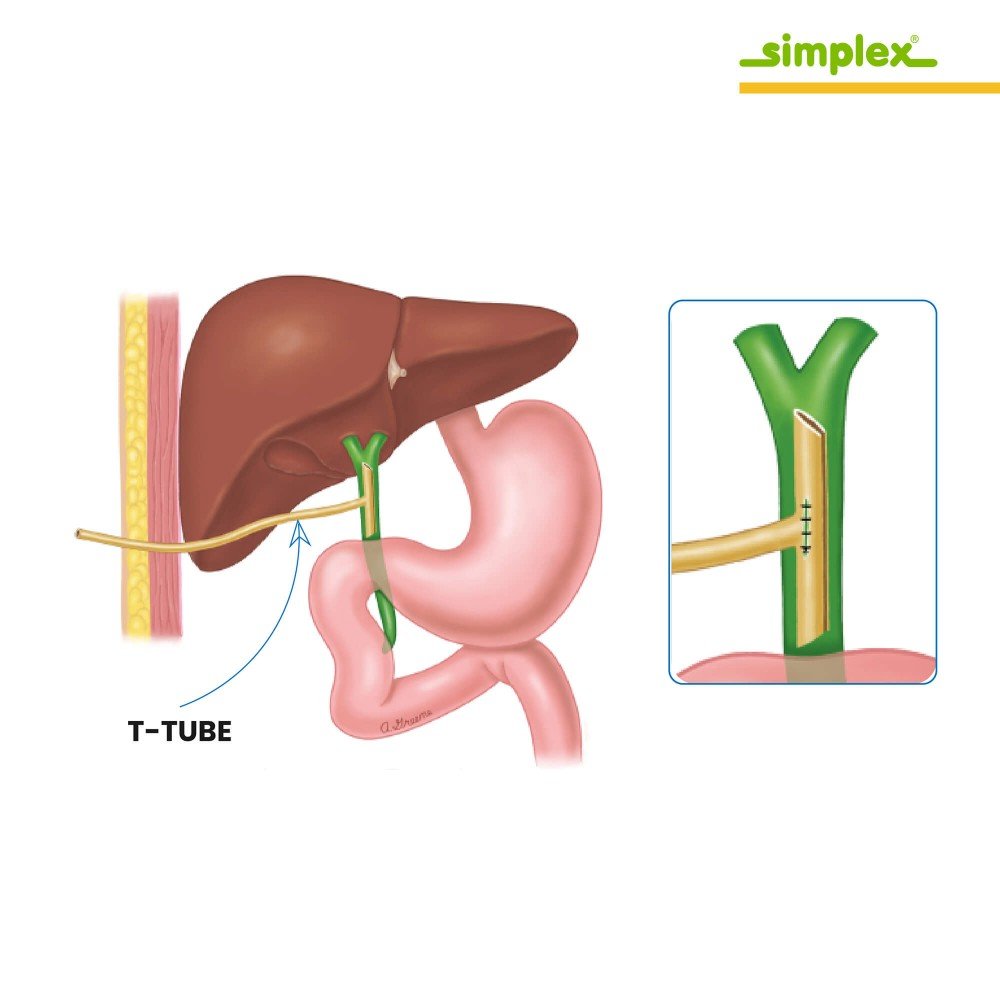 Simplex T-Tube Drain