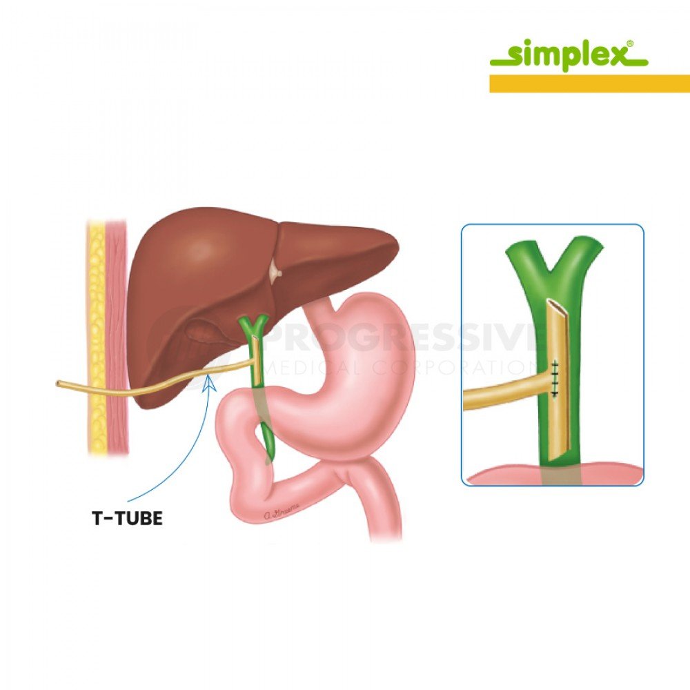 Simplex T-Tube Drain Simplex T-Tube Drain